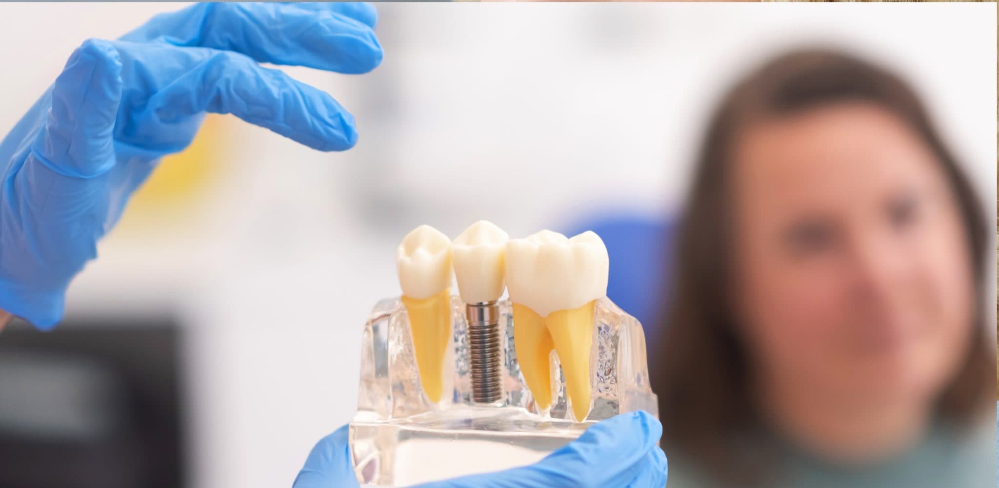 Dental Implants